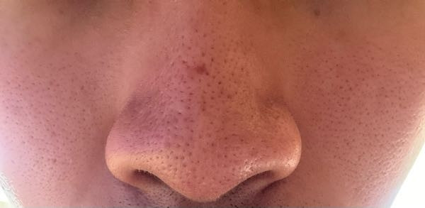 鼻の上の方にでかい毛穴があったので取ろうとしたら赤くなってしまったのですがこれは治りますか？ 後この開き毛穴どうやったら治りますか？