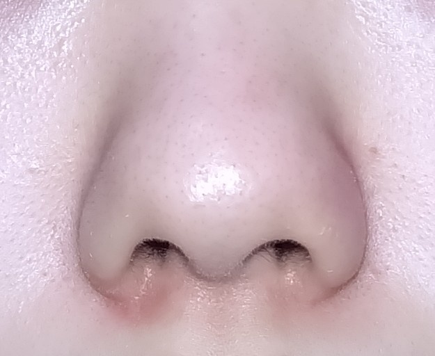 鼻がこんな感じで左右非対称です。 噛み合わが生まれつき悪いのですが顔の歪みと関係ありますか？ マッサージなどやって綺麗な鼻になりますでしょうか？ 整形しかありませんか？ 矯正以外で対処法お願いします