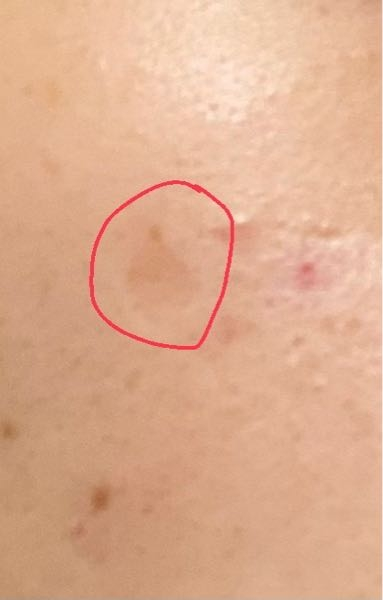 肌についてです。 分かりにくいですが、このような凹んだニキビ跡(?)は一生治りませんか？最近スキンケアをちゃんとし始めましたが、凹んでるのは治る気がしないので、詳しい方教えて頂けると助かります。