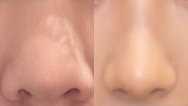 鼻整形についての相談です。 この左の鼻から、右のような鼻にする、または近づけるにはどのような施術が必要だと思われますか？
