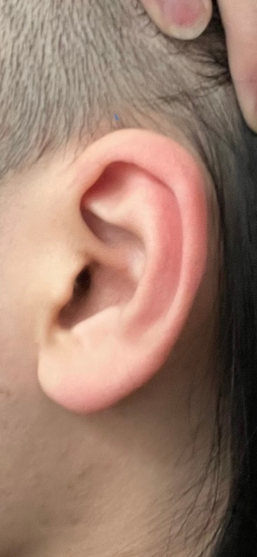 ピアスについての質問です。 アンテナヘリックスを開けたいと考えているんでがこの耳の形で開けることは可能でしょうか？