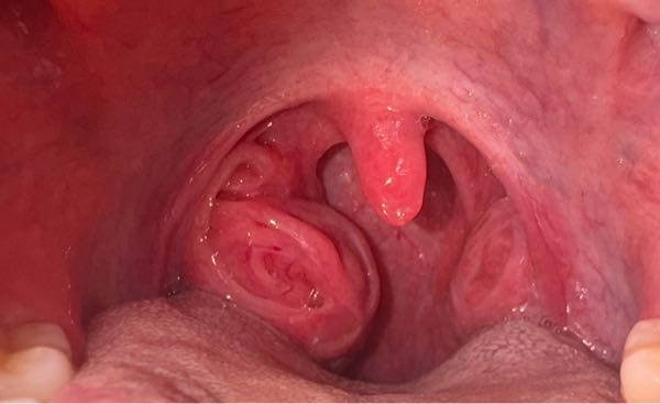 熱なし、痛みなしですか画像のように扁桃腺が腫れて飲み込みにくさや喋りにくさ、のど奥に詰まってる...