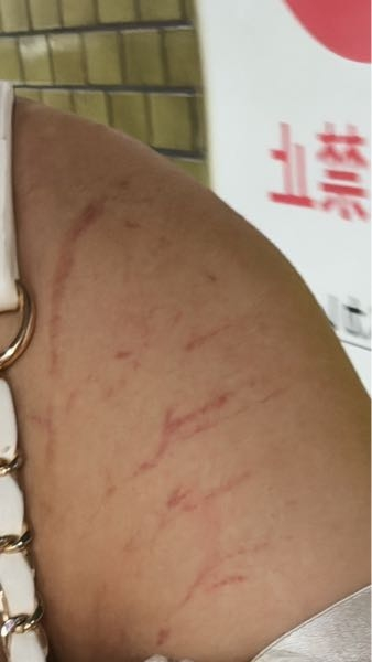 ユニバーサルスタジオのフライングダイナソーで 肩を怪我したと思うんですがこの傷はなんだと思いますか