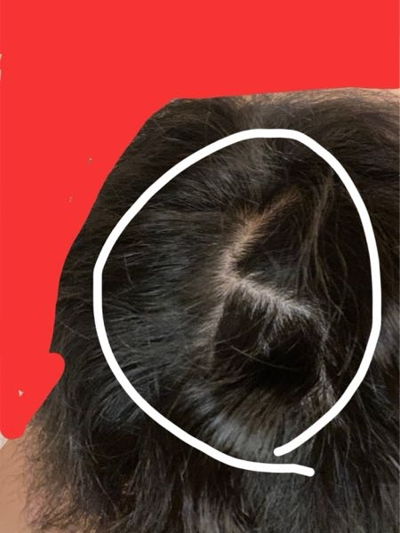 大至急！！美容師の方に質問です 先日、いつもの美容室でいつもの様にツイストスパイラルをあてました。 セットしてもらったときは気づかなかったのですがお風呂上がりに髪の毛に違和感があり、調べると根元折れみたいな症状になってます。 セットすれば隠せるかなーーって感じなんですが、美容師に相談すべきでしょうか？ いつも世話になってる方なので少し言いにくいです。 調べると放置してると最悪切れると出てくるのですが根元で切れてしまうのですか？ 教えてください。
