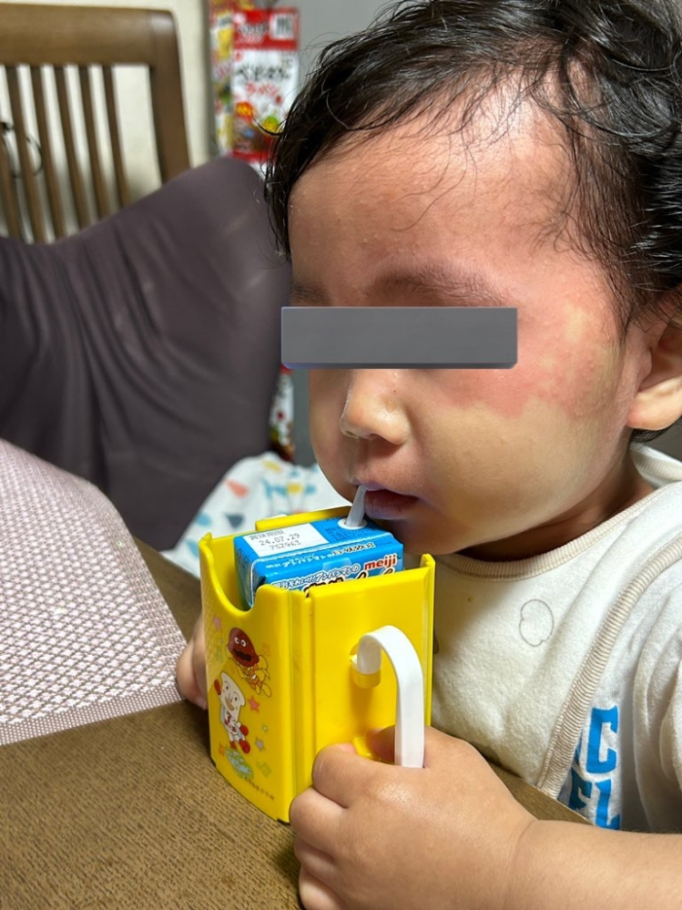 私の実家でご飯を食べていた時のことです。 もうすぐ2歳になる息子に盛岡冷麺をあげていました。離乳食は終わってるので、特に気にしないであげていたら、息子の顔半分が赤くなってぶつぶつも出てきました。今までアレルギーもなく通過して来れて初めてのことなので、異変に気づいてからは慌てて食べさせるのをやめました。 特に元気そうで肌も痒がることはなかったので、夕食時で病院も閉まってることもあり、家で様子見したら30分程で赤みもブツブツも消えました。 7歳と4歳の姪っ子は大丈夫だったので、両親もビックリしてました。 盛岡冷麺の袋を見ると、アルコールが含まれていますので、お年寄りや小さなお子様はお控えくださいとありました。 アレルギーとかではなく、アルコールに反応したのでしょうか？