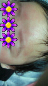 これは単なる乳児湿疹ですか 9月頭くらいに片側の頬に一センチくらいの発疹の Yahoo 知恵袋