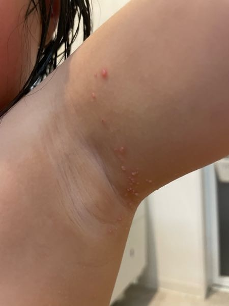子供の脇の下にこんなものが出来ています 最初は1つ、それがだんだん増えてきています たまに痒いと言いますが、お風呂上がりに少し痒そうにするだけで、その他は気にしている様子はありません 来週やっと皮膚科の予約がとれたので受診しますが、気になります 有識者の方ご存知ないでしょうか。