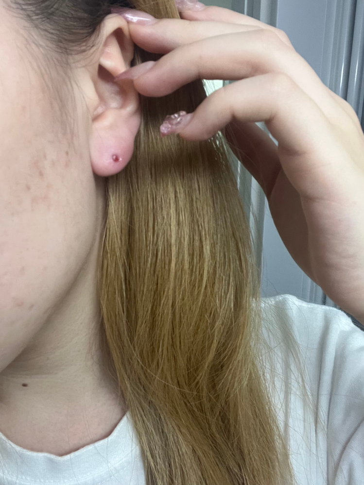 ピアスを開けて1ヶ月ほど経つのですが、左耳だけこのようになってしまいました。 こうなった場合はどうすべきでしょうか？また再発を防ぐためには普段どのようなことをすればよいですか？