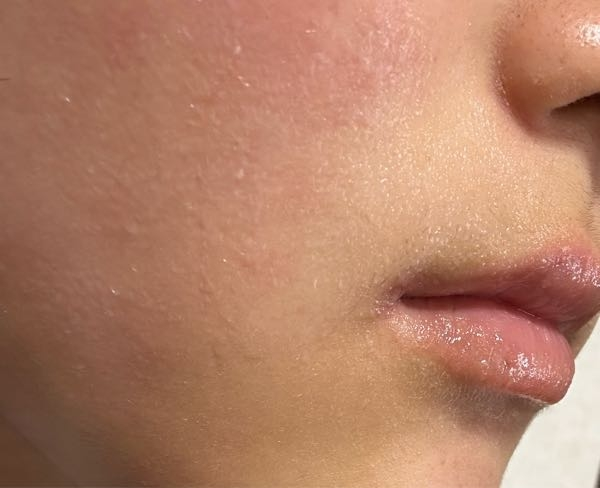 ほうれい線まわりが朝顔を洗うと乾燥します！ 毎日クレンジング、洗顔、化粧水、乳液、クリームまでしっかりやっているのですが、朝起きて顔をぬるま湯で洗うとほうれい線周りが少し乾燥しています。このまま毎朝乾燥してシミができてしまうのが怖いです。対処法はあるでしょうか? 画像は乾燥したのちの処置（化粧水と乳液）をした後なので潤っています。