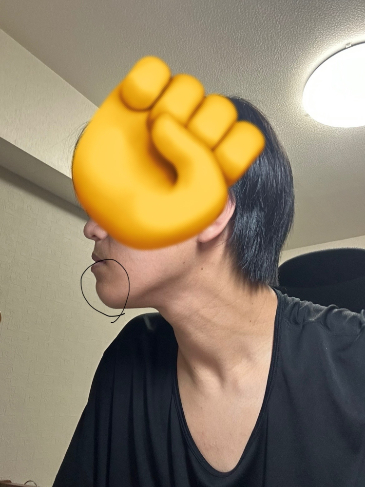 顔についての質問です。 顎のこの出っ張っている部分はどのようなことをしたらなくなりますか？ 痩せれば無くなったりします？