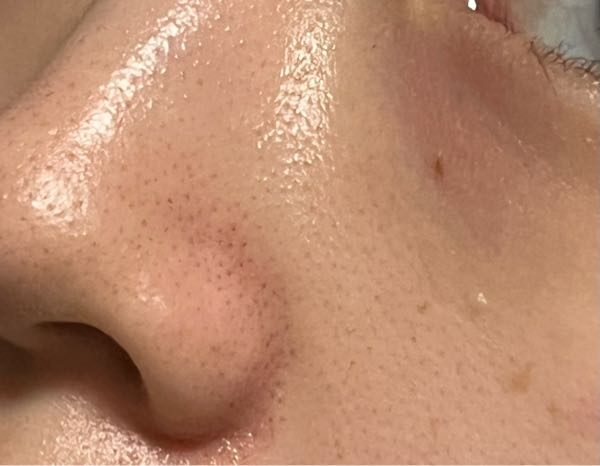 【注:汚肌のドアップが写ります】 いちご鼻で悩んでいます。 写真は入浴、スキンケア後です。 角栓取りパックを試してもほとんどついてないので、角栓ではないのかな？と思っているのですが、原因がよく分かりません。 肌質は恐らく乾燥肌で、触ってもザラザラはしません。 肌の赤みも気になるのですが、どうしたら改善されるでしょうか？