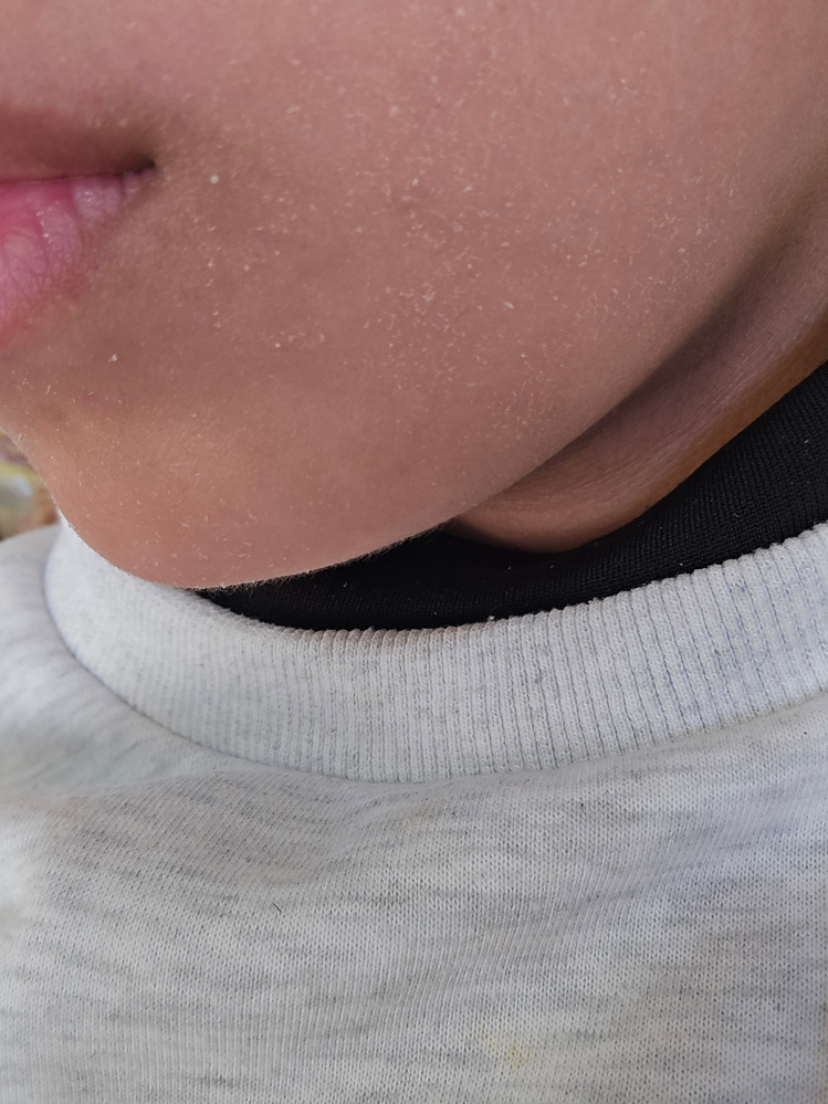 最近急に写真のように乾燥し始めました。ほんの少しだけ痒いです 空気が乾燥してるのかな、と思い今までより保湿もしてます 急になにか食べた、保湿を変えた、生活を変えたとかではありません どうしてでしょうか 保湿も塗っても塗っても数分でこうなります