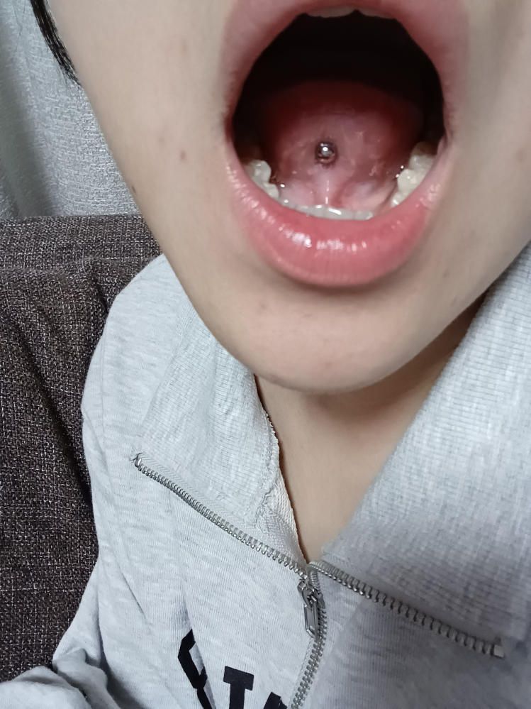 舌ピアス開けた時に、裏の筋に開けてしまったんですが大丈夫でしょうか？？ あと、筋に開けてしまった場合どうなりますか？