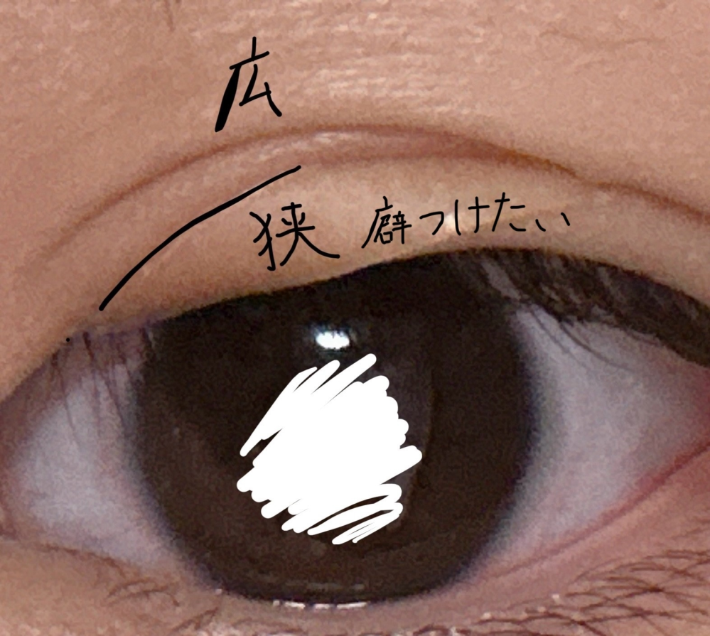 二重にしたいのに線が二つあって理想の二重になりません...もともと広い線があり、目が小さく見えるので狭い線をつくりました。 前まではその狭い線で固定されてたのですが、今は狭い線と広い線二つの線が混ざってます。 目頭ら辺は広い方の線で、目尻ら辺の線は狭い方の線です。絆創膏を使って癖をつけてきましたが、もう癖がつかないです。 どうしたらいいですか？アイプチで二重になれますかね？