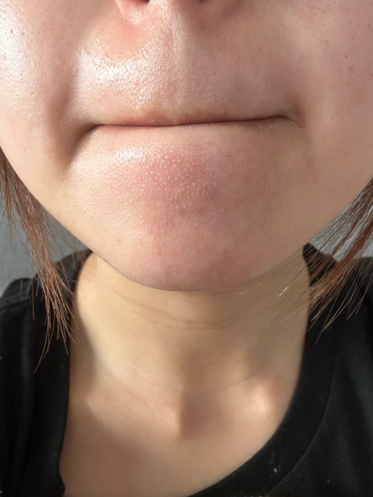 ニッキースキンクリアを買おうと思ってるんですが、現在使ってる人効果