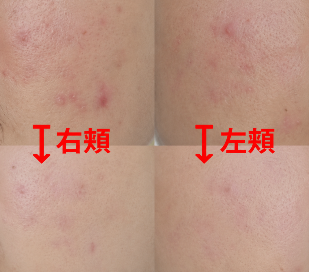 ニッキーズスキンクリア使ってます。ニキビとニキビ跡ですが今3カ月