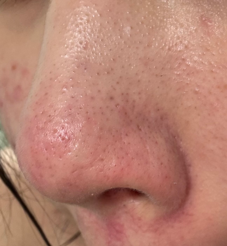ニッキーズスキンクリアの使用についてです。画像添付しますが開き毛穴