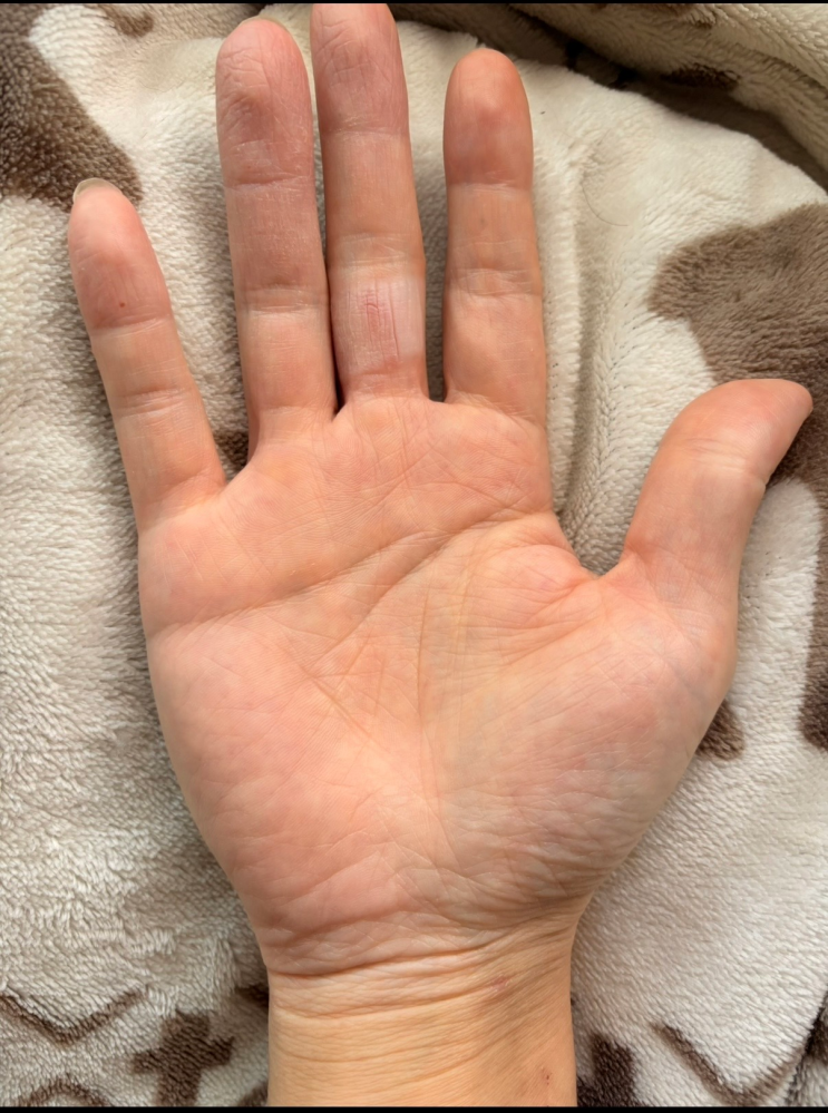 手相に詳しい方、教えてほしいです。右手の生命線に島があるのですが