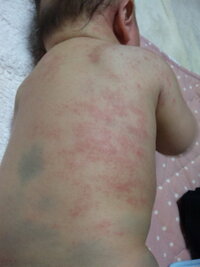 湿疹 画像あり 生後５ヶ月の子供のお腹と背中が赤くぶつぶつしてカサカサし Yahoo 知恵袋
