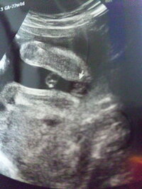 エコーでの性別判断お願いします 22ｗの時のエコーです エコーの見方がさっ Yahoo 知恵袋