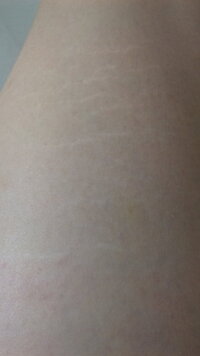 太ももの横に白い筋 線 みたいなのが入っています これ たまにあ Yahoo 知恵袋