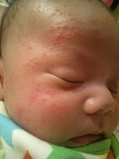 顔 乳児 湿疹