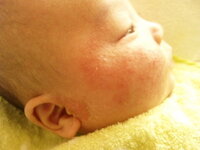 乳児湿疹について ２４日で生後３ヶ月になる男の子の赤ちゃんです Yahoo 知恵袋
