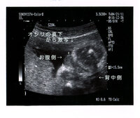 ２８週０日の 胎児のお股の超音波写真です 先生には 女の子だと言 Yahoo 知恵袋