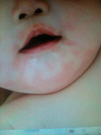 赤ちゃん 食べ物 アレルギー