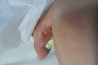 この指は壊死していますか 先日小指を骨折し ギブスで固定する際に小指と薬指 Yahoo 知恵袋
