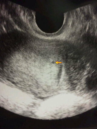 胎嚢の確認 大きさについて 現在妊娠初期なんですが 一番初 Yahoo 知恵袋