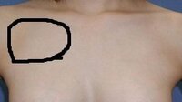 鎖骨下の腫れについて 数か月前から鎖骨下に腫れというか膨らみがあります こ Yahoo 知恵袋