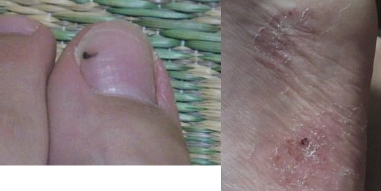 水虫 すべての質問 Yahoo 知恵袋