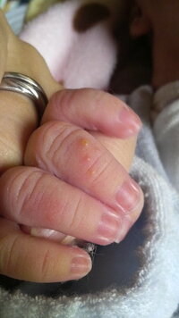 熟読する 学ぶ 面積 赤ちゃん 指 湿疹 Shigoto Michi Jp