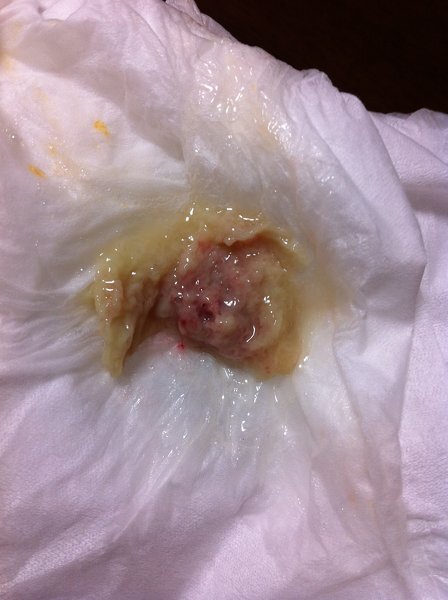 鼻を思い切り吸ったら膿 のようなものが喉から出てきました 画像も載せます Yahoo 知恵袋