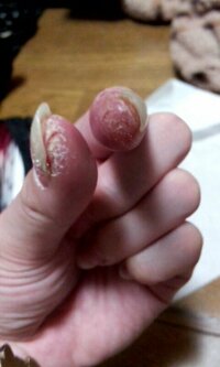 指の先の皮 爪の裏 の皮がむけ ひび割れのようになります ひび割れのクリー Yahoo 知恵袋