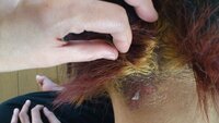 美容院で髪を染め頭皮に大きな火傷になりました 息子 16歳 Yahoo 知恵袋