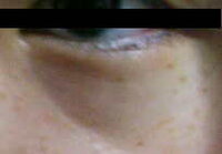 目の下のクマと線の解消方法についてです 画像の通り ひどいクマと線に悩んで Yahoo 知恵袋