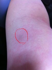画像あり 二の腕 肘の内側に小豆ぐらいの少し青っぽい しこりの Yahoo 知恵袋