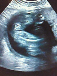 現在 妊娠27週目です 25週目のエコー写真ですが 女の子かな って言われた Yahoo 知恵袋