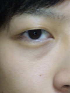 目の隈 Periorbital Dark Circles Japaneseclass Jp