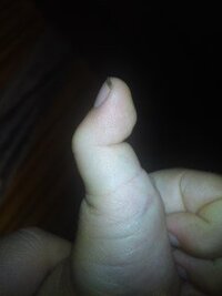 ４歳の娘の左手の親指なんですが 真っ直ぐにならないし 反りません Yahoo 知恵袋