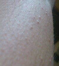 腕とかにできる赤いブツブツ 画像有 の名称はなんですか 毛 Yahoo 知恵袋