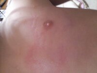 虫刺され じんましん 五才の子供ですが 太もも 背中 胸 おしり 脇 Yahoo 知恵袋