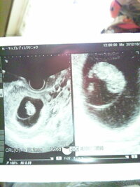 卵黄嚢 画像は妊娠8週目ですが赤ちゃんの回りにある白いリングに見 Yahoo 知恵袋