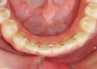 歯列矯正後のリテーナーについて 質問します 下の画像のフィックス Yahoo 知恵袋