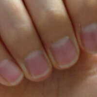 はがれたつめは元に戻りますか 綺麗に戻る ぼこぼこする 後遺症でしびれや Yahoo 知恵袋