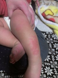 至急 赤ちゃんの低温やけどについて 1歳の子供をおんぶした Yahoo 知恵袋