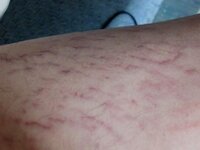 これって 所謂 妊娠線 肉割れ ですよね 気持ち悪いです Yahoo 知恵袋