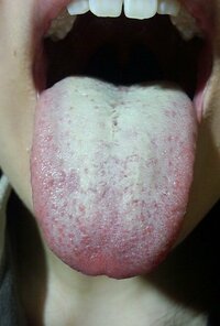 舌苔について 画像あり ここ何年もずっと舌苔に悩んでいます とにかく真っ白な Yahoo 知恵袋